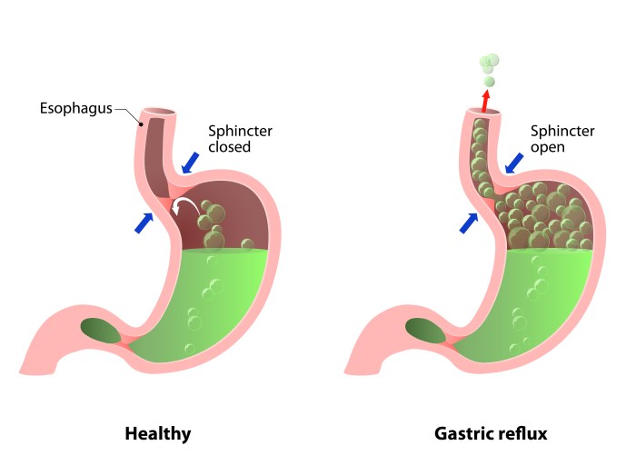 Gastric juices correct